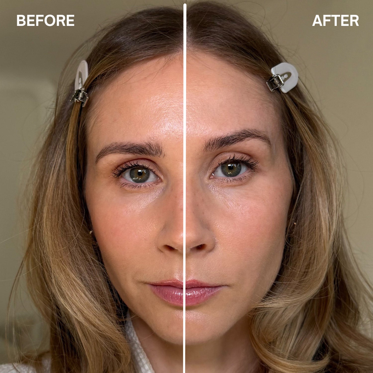 Facefixers Eyelifting Before and After